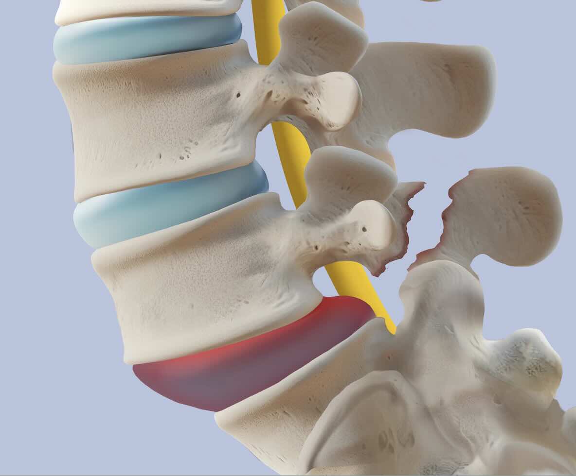 Tratamiento de espondilolistesis lumbar en Guadalajara