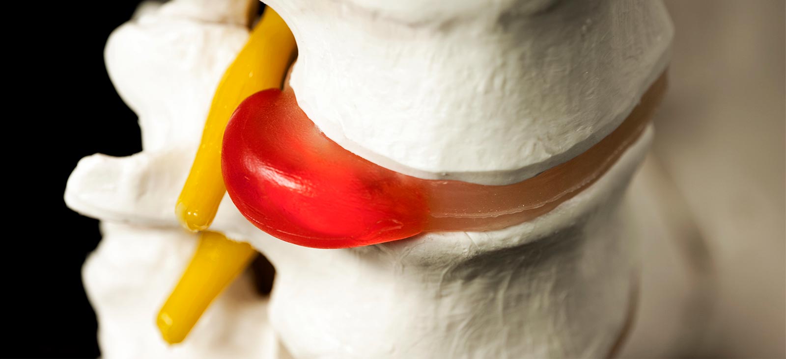 Tratamiento de hernia de disco lumbar en Guadalajara