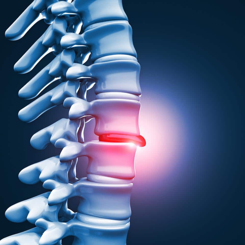 Tratamiento de hernia discal cervical en Guadalajara